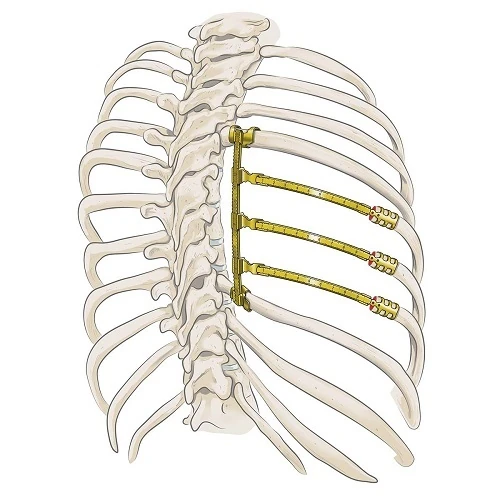 STRATOS - Reconstrucción Paravertebral