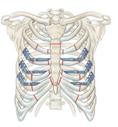 medxpert__product_category__chest_wall_deformities.webp